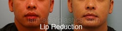 Lip Reduction Before & After