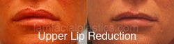 Lip Reduction Before & After