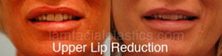 Lip Reduction Before & After