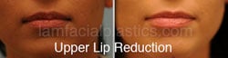 Lip Reduction Before & After