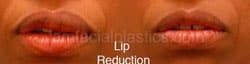 Lip Reduction Before & After