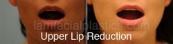 Lip Reduction Before & After