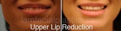 Lip Reduction Before & After
