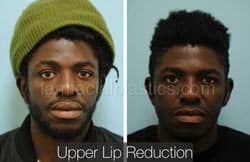 Lip Reduction Before & After