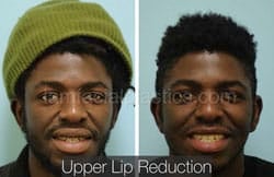 Lip Reduction Before & After