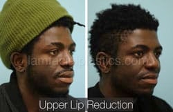 Lip Reduction Before & After
