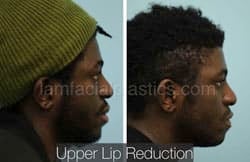 Lip Reduction Before & After