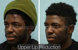 Lip Reduction Before & After