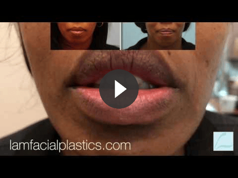 lip reduction video