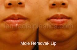 Mole Removal Before & After