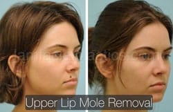 Mole Removal Before & After