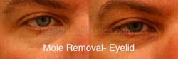 Mole Removal Before & After