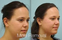 Mole Removal Before & After