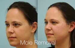 Mole Removal Before & After
