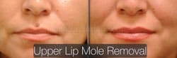 Mole Removal Before & After