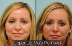 Mole Removal Before & After