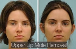 Mole Removal Before & After