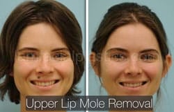 Mole Removal Before & After