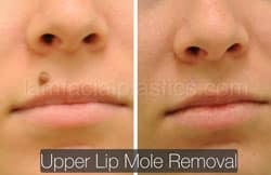 Mole Removal Before & After