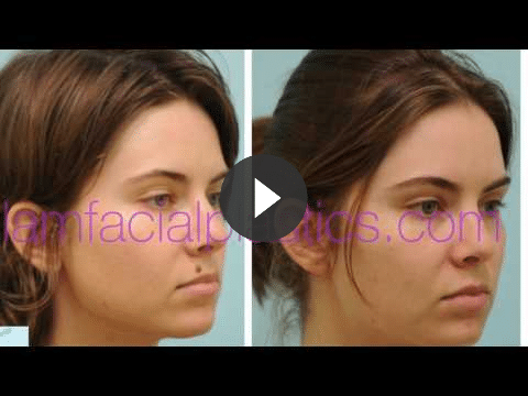 mole removal video