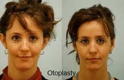 Otoplasty Surgery Results Dallas Texas