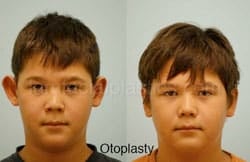 Otoplasty Surgery Results Dallas Texas