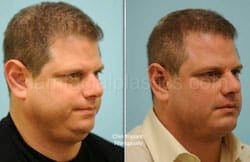 Otoplasty Surgery Results Dallas Texas