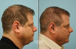 Otoplasty Surgery Results Dallas Texas