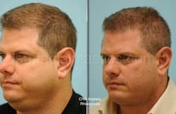 Otoplasty Surgery Results Dallas Texas
