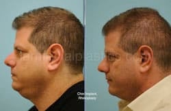 Otoplasty Surgery Results Dallas Texas