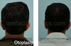 Otoplasty Surgery Results Dallas Texas