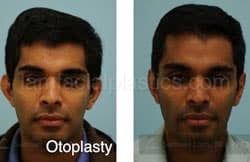 Otoplasty Surgery Results Dallas Texas