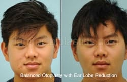 Otoplasty Surgery Results Dallas Texas