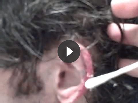 otoplasty video