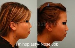 Rhinoplasty Before and After Plano, TX