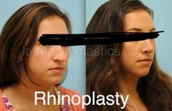Rhinoplasty Before and After Plano, TX