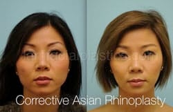 Rhinoplasty Before and After Plano, TX