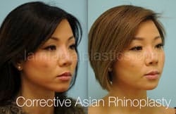 Rhinoplasty Before and After Plano, TX