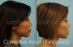 Rhinoplasty Before and After Plano, TX