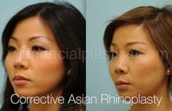 Rhinoplasty Before and After Plano, TX