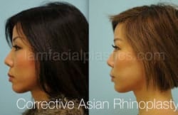 Rhinoplasty Before and After Plano, TX
