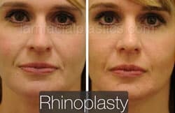 Rhinoplasty Before and After Plano, TX