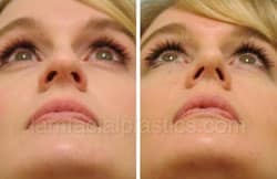 Rhinoplasty Before and After Plano, TX