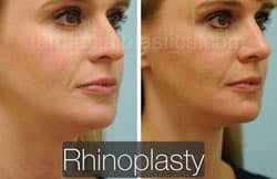 Rhinoplasty Before and After Plano, TX