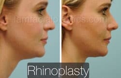 Rhinoplasty Before and After Plano, TX