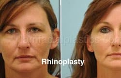 Rhinoplasty Before and After Plano, TX