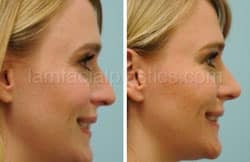 Rhinoplasty Before and After Plano, TX