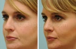 Rhinoplasty Before and After Plano, TX