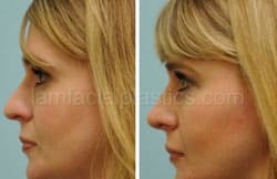 Rhinoplasty Before and After Plano, TX