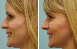Rhinoplasty Before and After Plano, TX